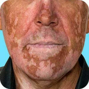 Homeopathic Vitiligo Treatment_How common is Vitiligo_https://www.bharathomeopathy.com/