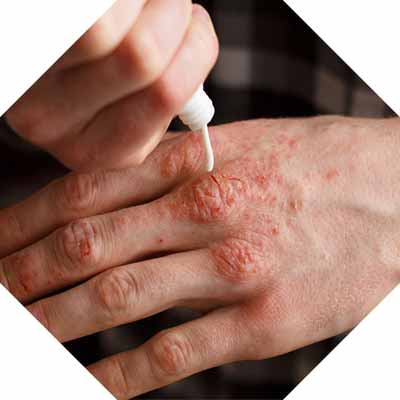 Homeopathic Psoriasis Treatment_Cure_https://www.bharathomeopathy.com/