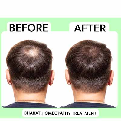 pre & pro treatment_www.bharathomeopathy.com