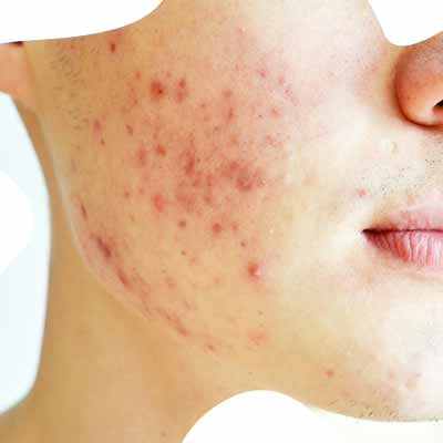 causes acne to develop_www.bharathomeopathy.com