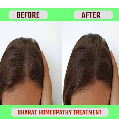 pre & pro treatment_www.bharathomeopathy.com