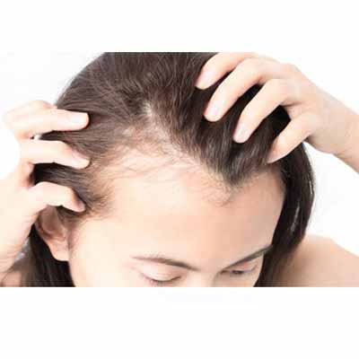 Hair fall in women_www.bharathomeopathy.com