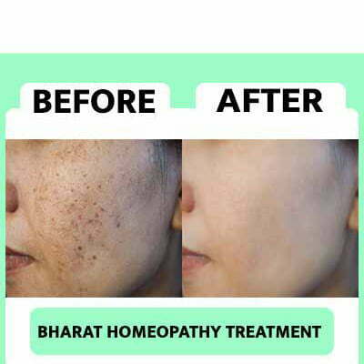 Pre & Pro Treatment_www.bharathomeopathy.com