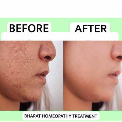 Pre & Pro Treatment_www.bharathomeopathy.com