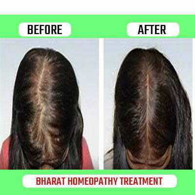 Pre & Pro Treatment_www.bharathomeopathy.com