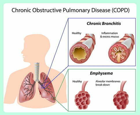 emphysema and chronic bronchitis_www.bharathomeopathy.com