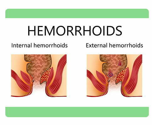 Symptoms of Piles_www.bharathomeopathy.com