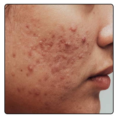 WHAT ARE PIMPLES? ARE THEY OF DIFFERENT TYPES? Treatment_www.bharathomeopathy.com
